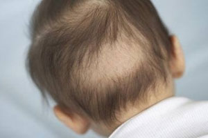 Cần biết về hiện tượng rụng tóc ở trẻ sơ sinh