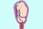 Cách phòng ngừa sa dây rốn trong thai kỳ