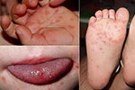 Những dấu hiệu bệnh tay chân miệng ở trẻ, phụ huynh chớ bỏ qua